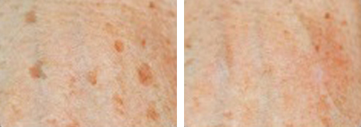 Ähnlich wie Muttermale oder Sommersprossen sind Altersflecken Pigmentstörungen. | RPM Medical & Kosmetik Rafael-Peter Mischewski Mönchengladbach Ähnlich wie Muttermale oder Sommersprossen sind Altersflecken Pigmentstörungen. | RPM Medical & Kosmetik Rafael-Peter Mischewski Mönchengladbach