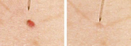 Blutschwämmchen, medizinisch als Hämangiome bezeichnet, sind gutartige Hautveränderungen. | RPM Medical & Kosmetik Rafael-Peter Mischewski Mönchengladbach Blutschwämmchen, medizinisch als Hämangiome bezeichnet, sind gutartige Hautveränderungen. | RPM Medical & Kosmetik Rafael-Peter Mischewski Mönchengladbach