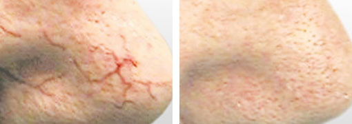 Die Couperose ist eine anlagebedingte Erweiterung der kleinsten Blutgefäße im Gesicht. | RPM Medical & Kosmetik Rafael-Peter Mischewski Mönchengladbach Die Couperose ist eine anlagebedingte Erweiterung der kleinsten Blutgefäße im Gesicht. | RPM Medical & Kosmetik Rafael-Peter Mischewski Mönchengladbach