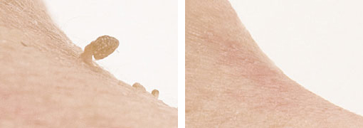 Fibrome sind gutartige Veränderungen in der Haut, die sich als kleine Knötchen überall am Körper bilden können. | RPM Medical & Kosmetik Rafael-Peter Mischewski Mönchengladbach Fibrome sind gutartige Veränderungen in der Haut, die sich als kleine Knötchen überall am Körper bilden können. | RPM Medical & Kosmetik Rafael-Peter Mischewski Mönchengladbach
