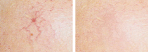 Die Couperose ist eine anlagebedingte Erweiterung der kleinsten Blutgefäße im Gesicht. | RPM Medical & Kosmetik Rafael-Peter Mischewski Mönchengladbach Die Couperose ist eine anlagebedingte Erweiterung der kleinsten Blutgefäße im Gesicht. | RPM Medical & Kosmetik Rafael-Peter Mischewski Mönchengladbach