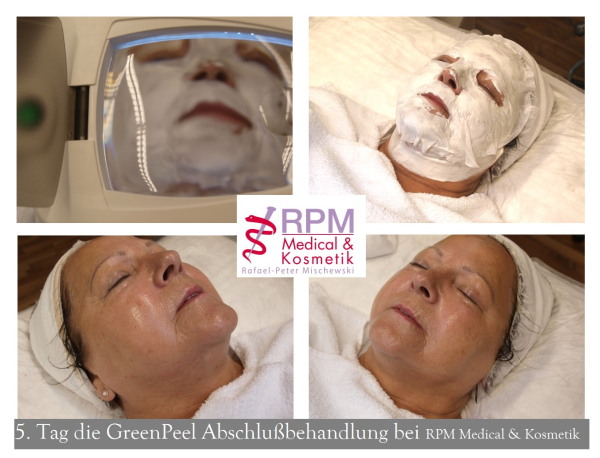 Behandlungstag Nr. 5 - Green Peel classic® (Tag der Beauty Finish Behandlung) | RPM Medical & Kosmetik Rafael-Peter Mischewski Mönchengladbach