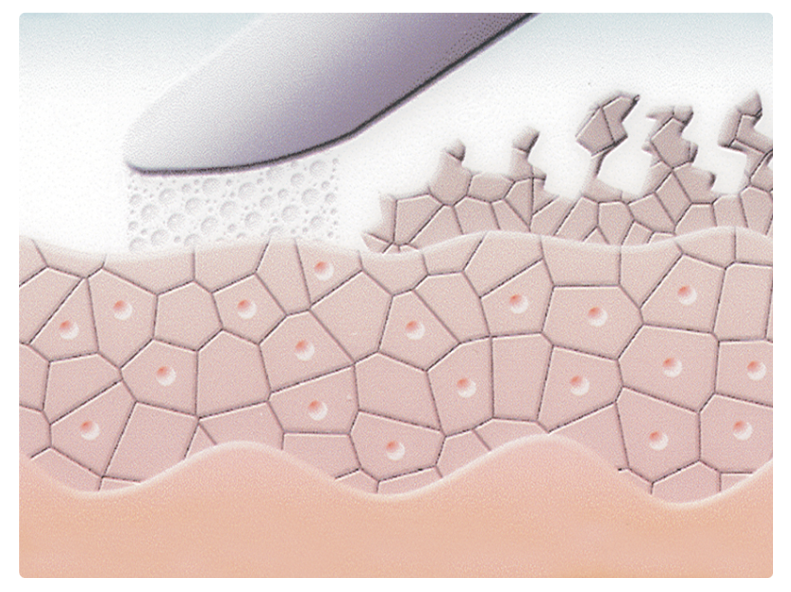 Die Microdermabrasion mit dem REVIDERM SkinPeeler trägt Hornzellen ab. Hornschicht  (Stratum corneum): Die äußere Schicht der Epidermis besteht je nach Körperareal im Schnitt aus etwa 20 Zellschichten, die sich aus abgeflachten, abgestorbenen Hornzellen zusammensetzen. Diese abgestorbenen Zellen werden regelmäßig abgestoßen bzw. abgeschuppt.  Die Hornschicht beherbergt auch die Poren der Schweißdrüsen und die Öffnungen der Talgdrüsen. | RPM Medical & Kosmetik Rafael-Peter Mischewski Mönchengladbach