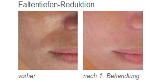 Vorher-/Nachher-Bilder Faltentiefen-Reduktion mit LDM®-Sonoskin | RPM Medical & Kosmetik Rafael-Peter Mischewski Mönchengladbach