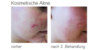 Vorher-/Nachher-Bilder Kosmetische Akne mit LDM®-Sonoskin | RPM Medical & Kosmetik Rafael-Peter Mischewski Mönchengladbach
