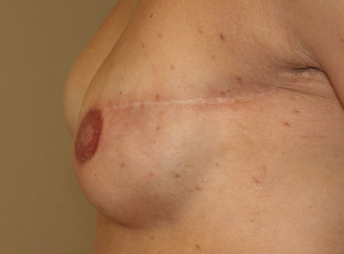 paraMEDizinische Brustpigmentierung mittels spezieller 3-D-Technik - seitliche Ansicht | RPM Medical & Kosmetik Rafael-Peter Mischewski Mönchengladbach