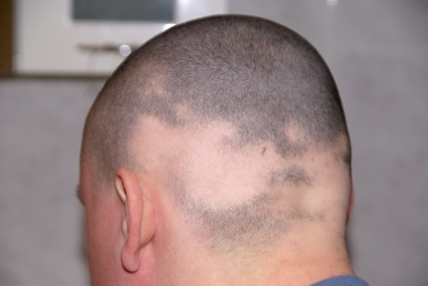 Patient mit Alopecia areata - kreisrunder Haarausfall | RPM Medical & Kosmetik Rafael-Peter Mischewski Mönchengladbach